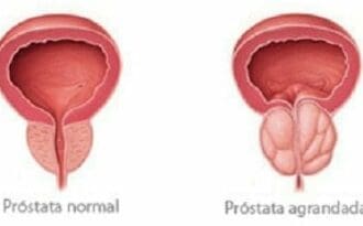 Cancer de prostata localizacion