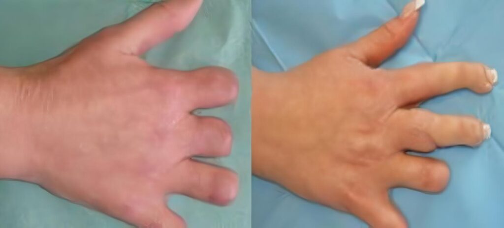 Primeros Reimplantes de Miembros
