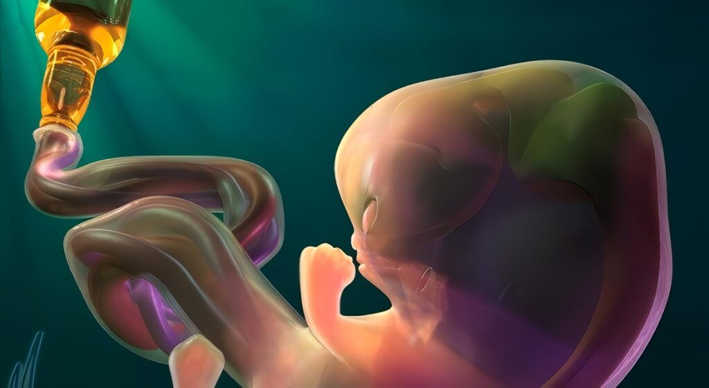 Síndrome Fetal Alcohólico
