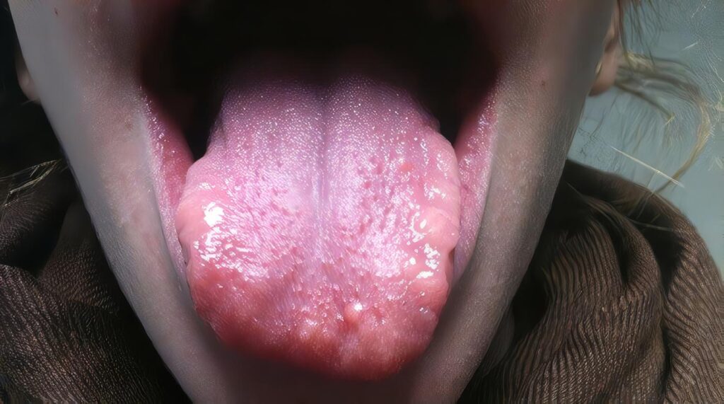 Síndrome de neoplasia endocrina múltiple (MEN I)
