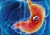 Tamizaje de Cáncer Gástrico