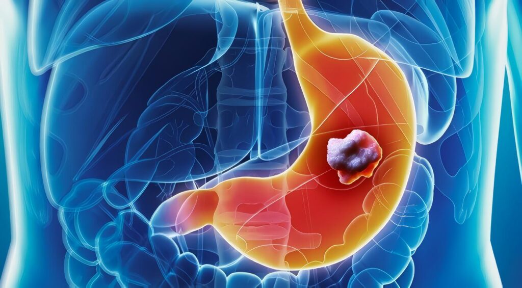 Tamizaje de Cáncer Gástrico