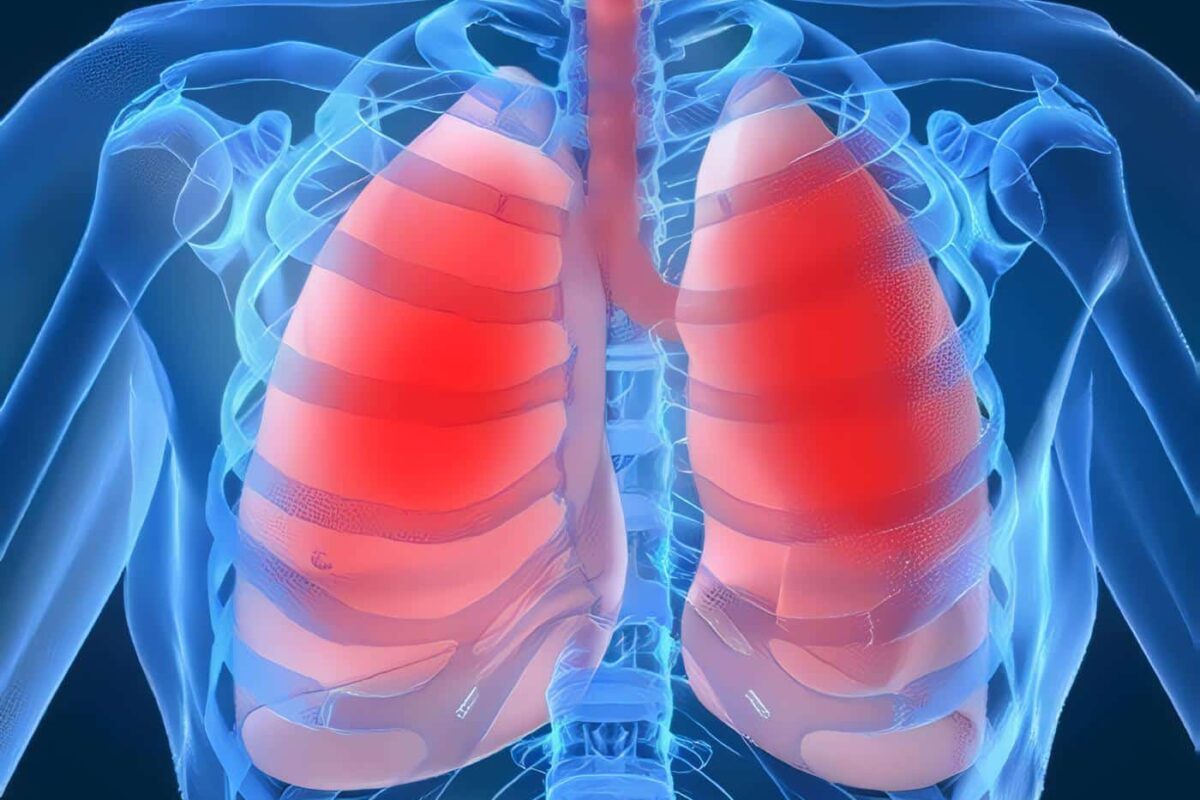 Tuberculosis Extrapulmonar