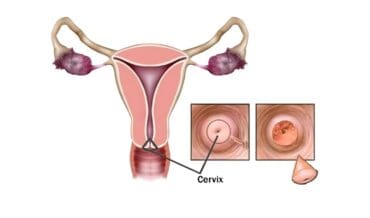 Virus y cáncer de cuello uterino