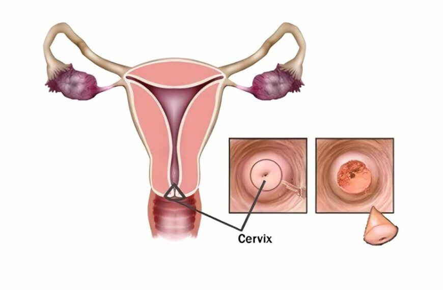 Virus y cáncer de cuello uterino