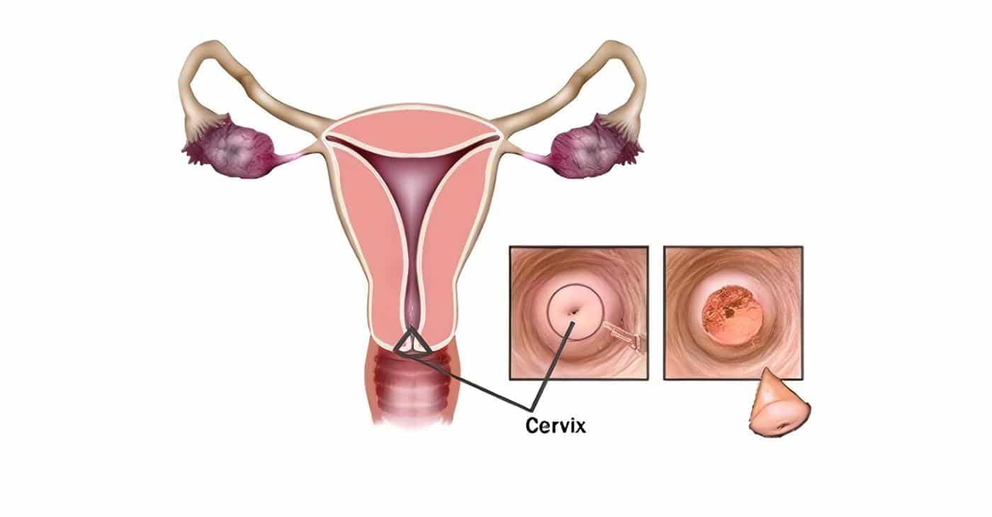 Virus y cáncer de cuello uterino