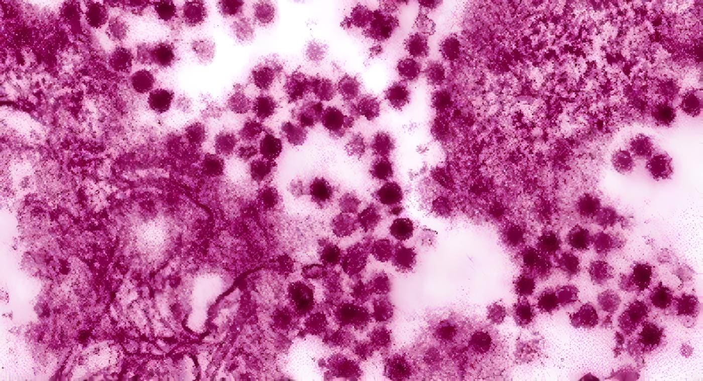 Virus del Nilo Occidental