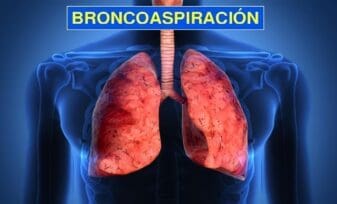 Broncoaspiración