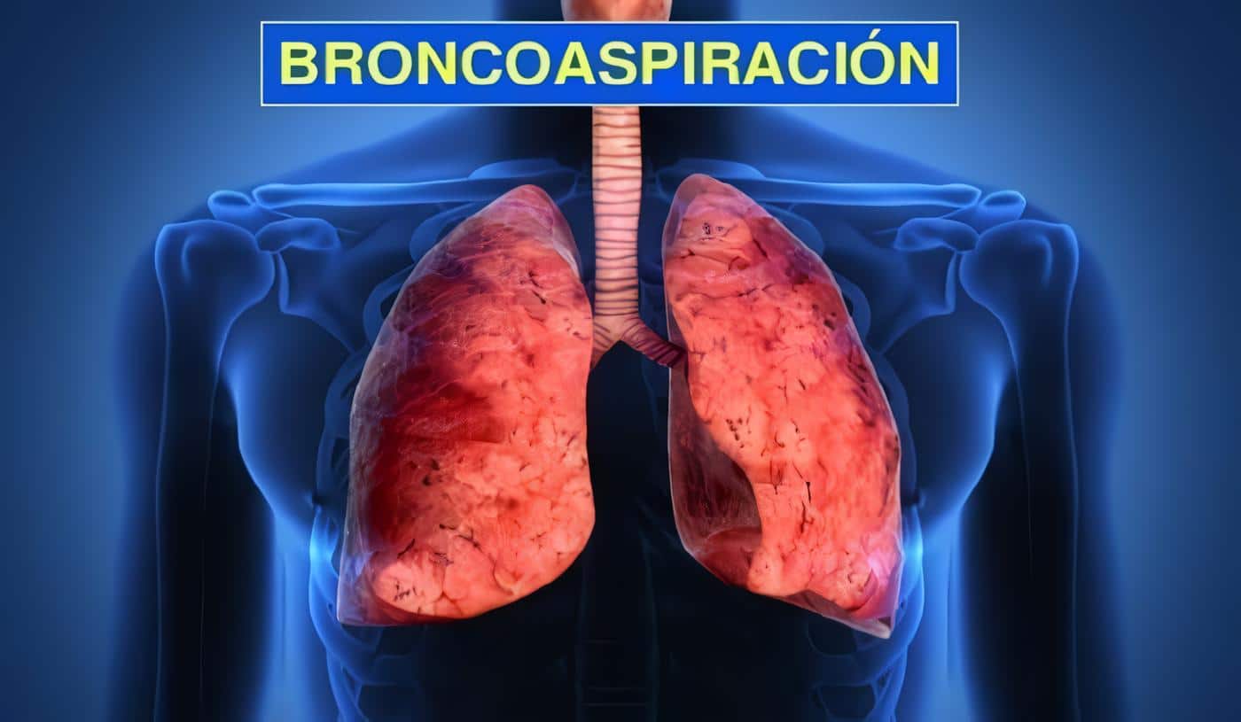 Broncoaspiración