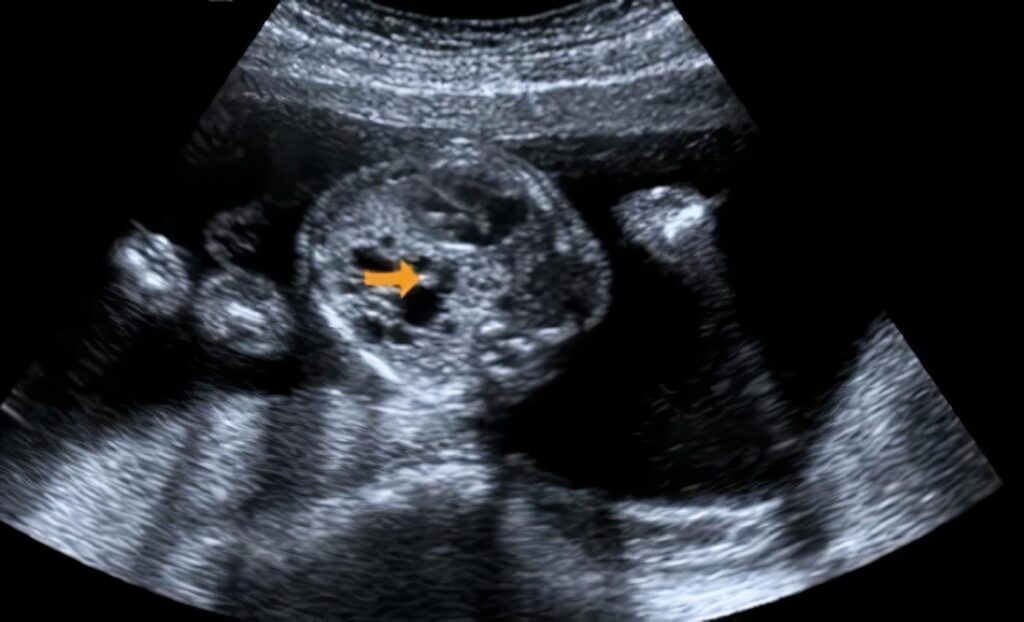 Malformación Adenomatoide Quística