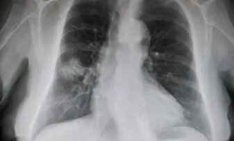 Abscesos pulmonares apicales