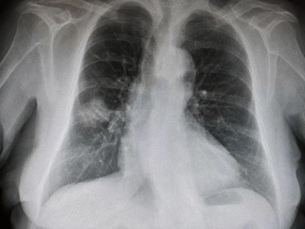 Abscesos pulmonares apicales