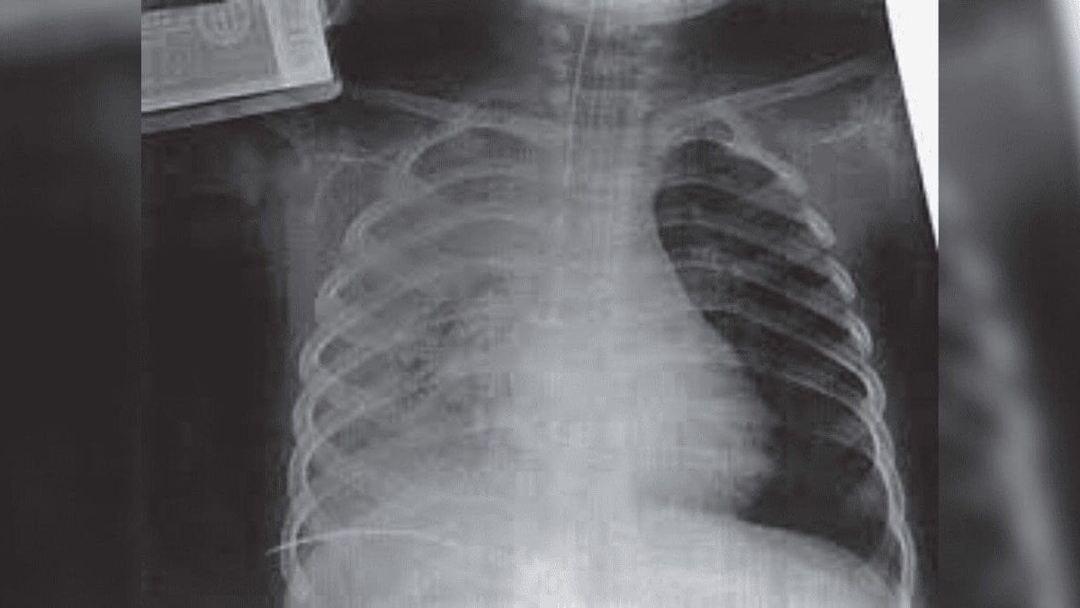 Características clínicas de la contusión pulmonar en niños