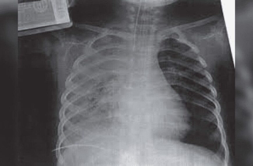 Características clínicas de la contusión pulmonar en niños