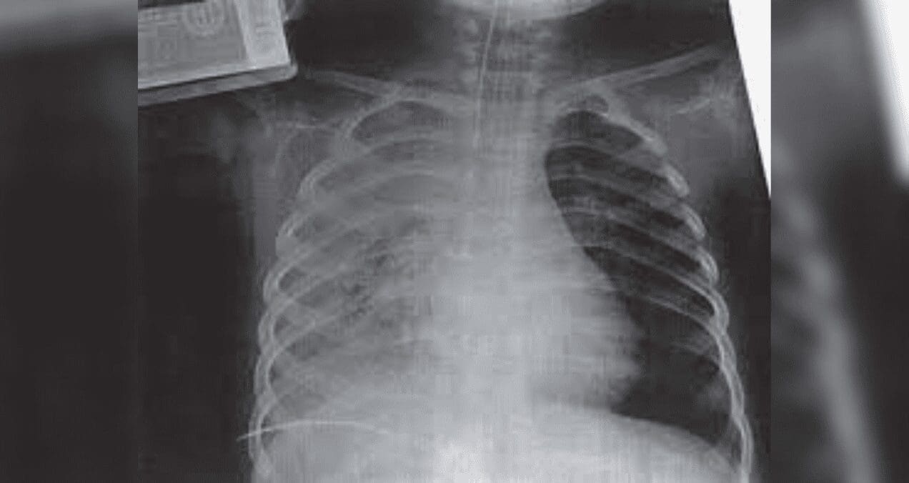 Características clínicas de la contusión pulmonar en niños