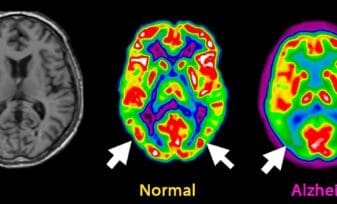 Enfermedad de Alzheimer Diagnóstico