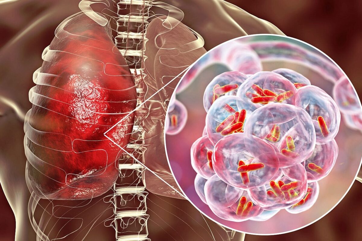 Manejo de la tuberculosis resistente a múltiples medicamentos