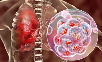 Manejo de la tuberculosis resistente a múltiples medicamentos