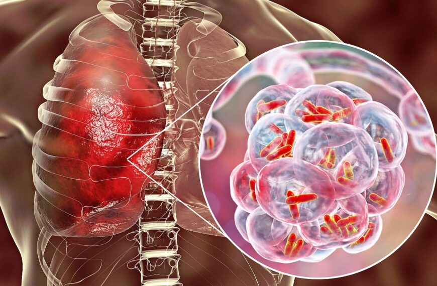 Manejo de la tuberculosis resistente a múltiples medicamentos