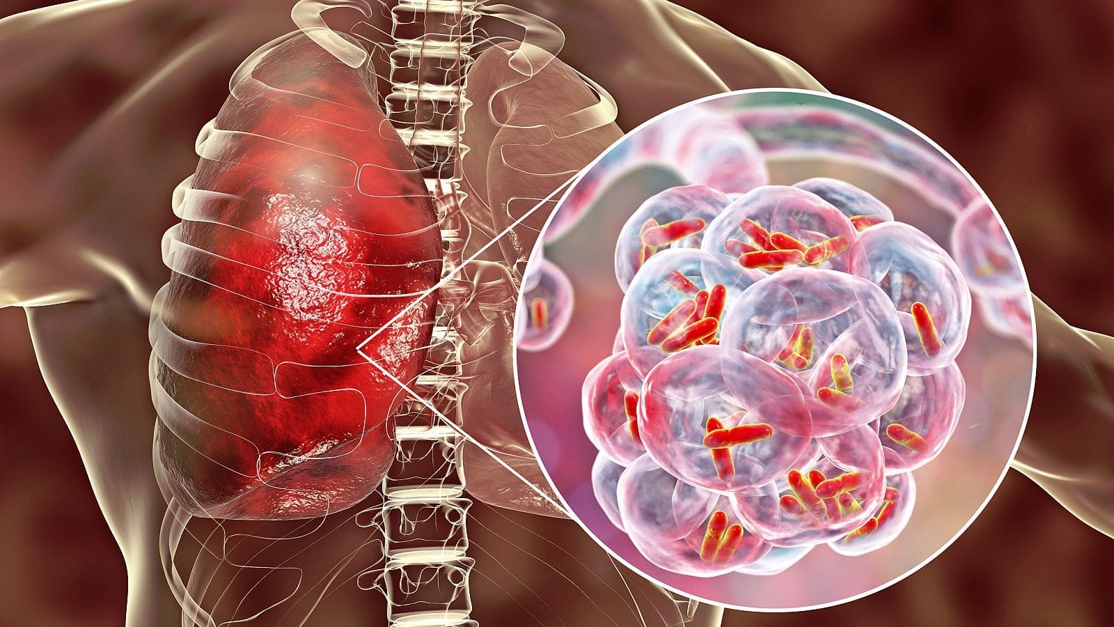 Manejo de la tuberculosis resistente a múltiples medicamentos