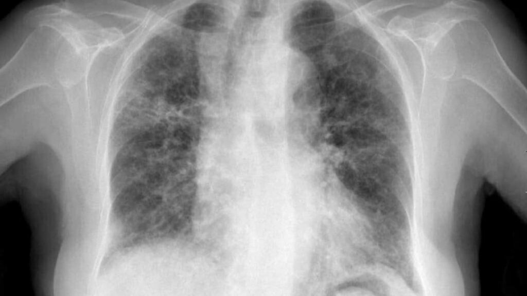 Neumonía intersticial aguda