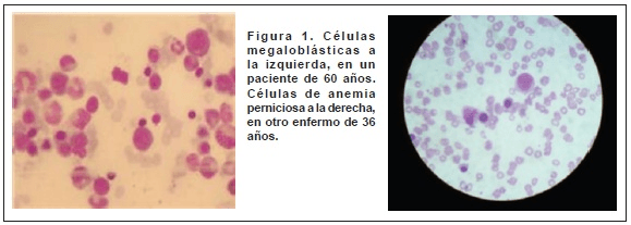 Células megaloblásticas y Células de anemia