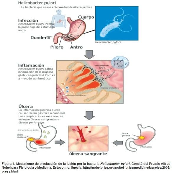 Lesión por la bacteria Helicobacter pylori