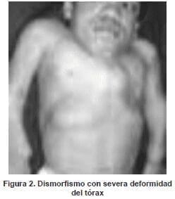 Dismorfismo con severa deformidad del tórax Dismorfismo con severa deformidad del tórax