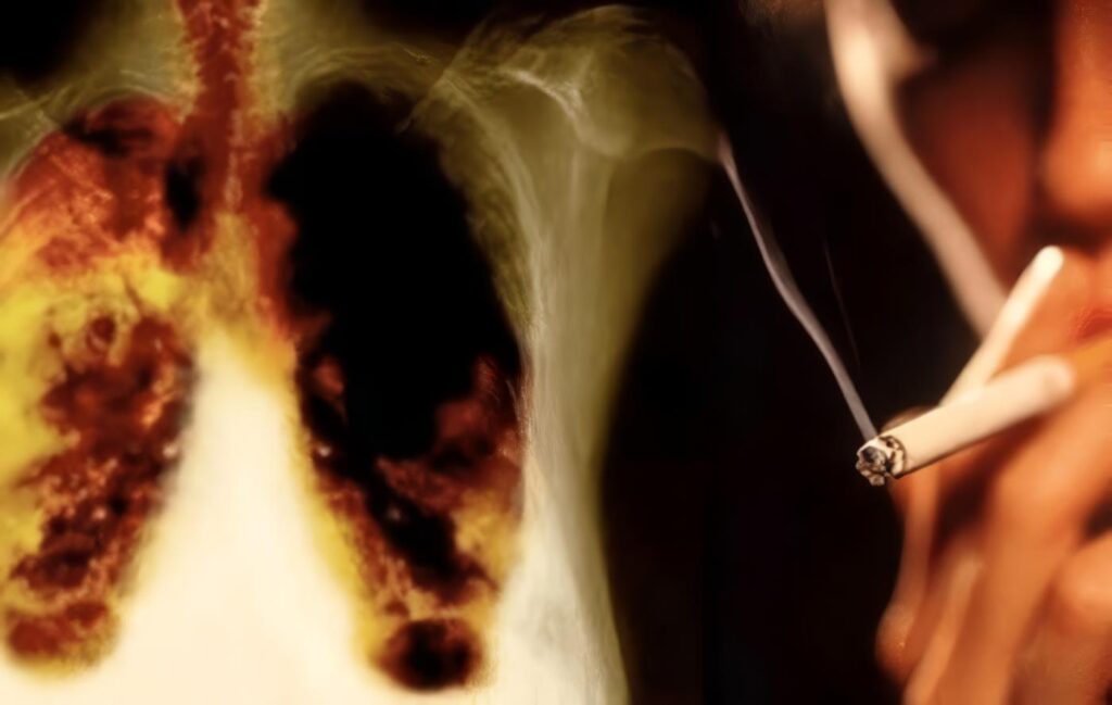 Bronquitis Crónica