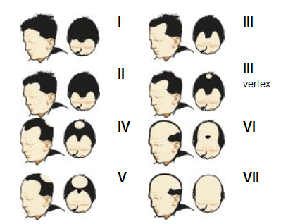 Alopecia masculina
