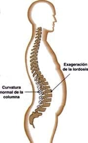 Hiperlordosis - Dolor Lumbar - Espalda