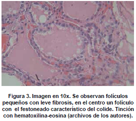 Folículos pequeños con leve fibrosis