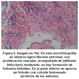 Fibrosis estromal