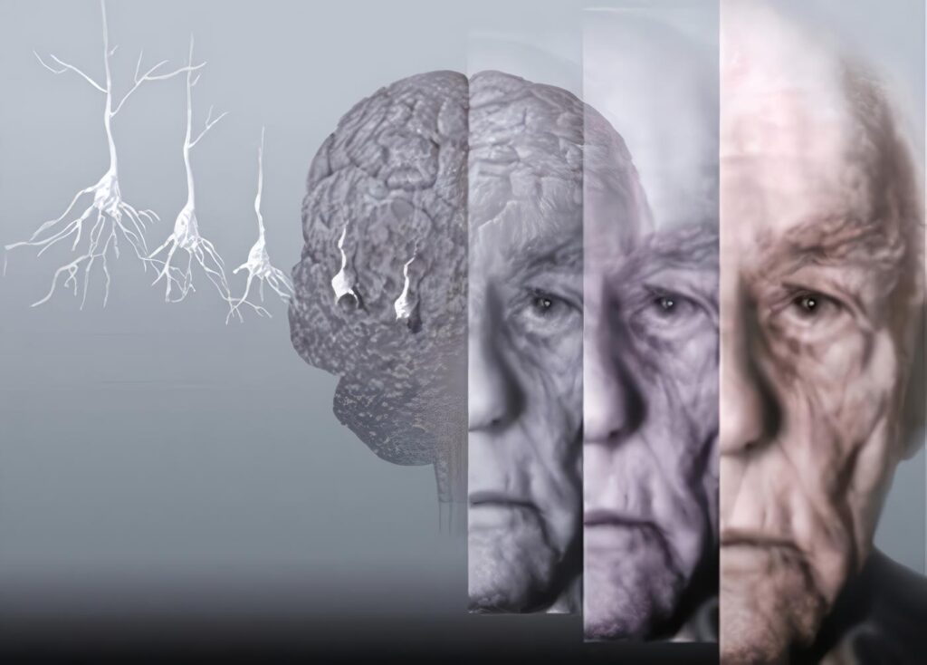 guía de alzheimer