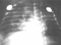 Radiografía de tórax con imágenes hiperlúcidas