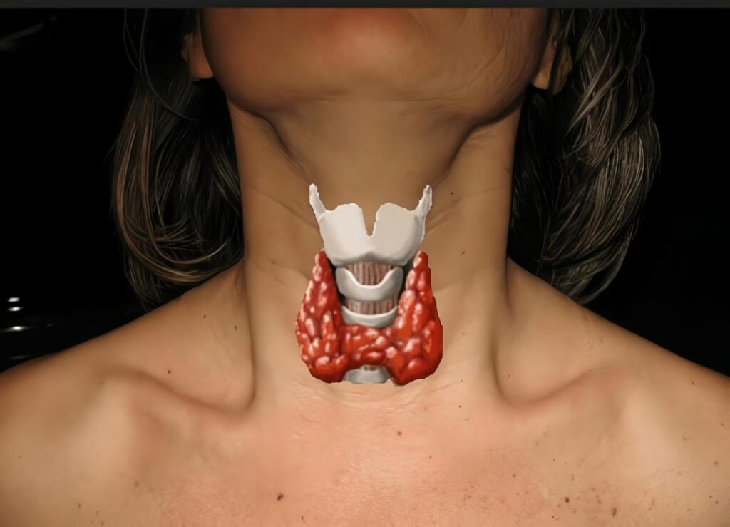 Tiroiditis Crónica