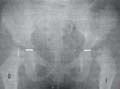 Radiografia anteroposterior de pelvis mostrando línea del Hilgenreiner 