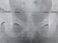 Radiografía anteroposterior con acercamiento para mostrar zona de formación de gota de lágrima
