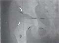 Radiografía anteroposterior centrada en cadera derecha