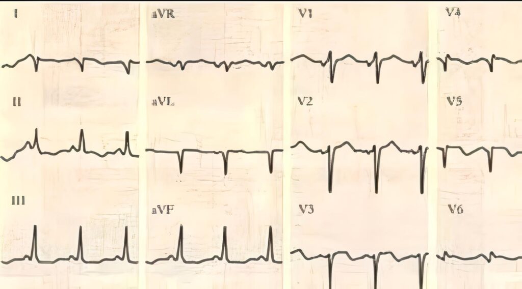 Electrocardiograma