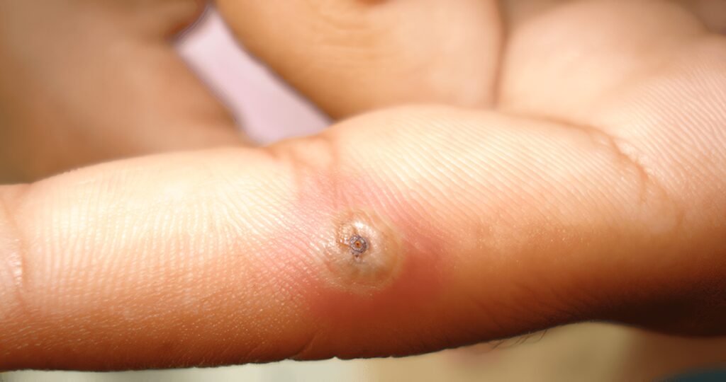 Investigación Original,  Tungiasis en Población Indígena del Departamento de Vaupés