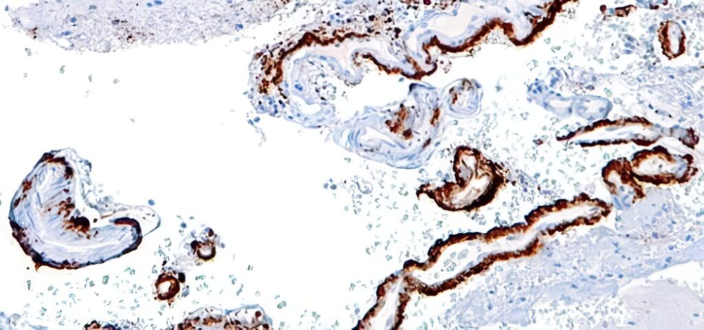 Nuevo Gen Asociado al Desarrollo de Placas Amiloides