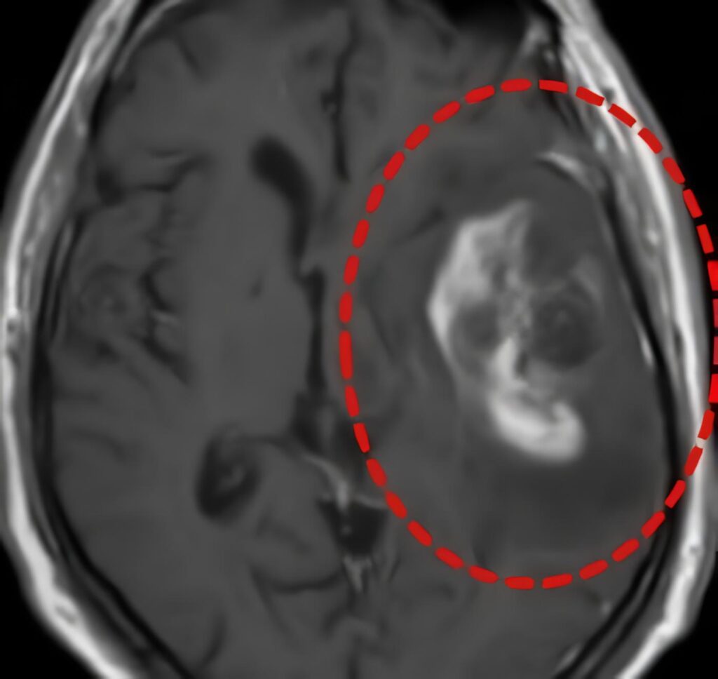 Pacientes con Gliobastoma Multiforme