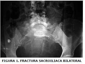 Fractura sacroiliaca bilateral