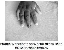 Necrosis seca dedo medio mano, Anemia de Células Falciformes