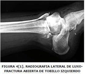 Radiografía lateral de luxofractura