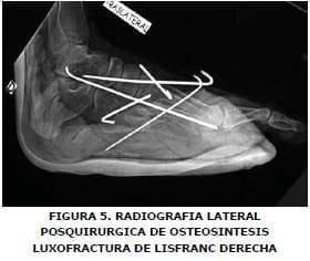 Radiografía lateral de Osteosintesis Luxofractura