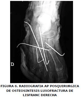 Radiografía AP posquirúrgica