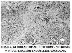 Glioblastoma multiforme necrosis
