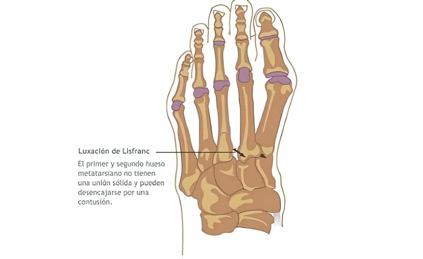 Luxofractura de Lisfranc